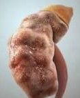 kidney 5